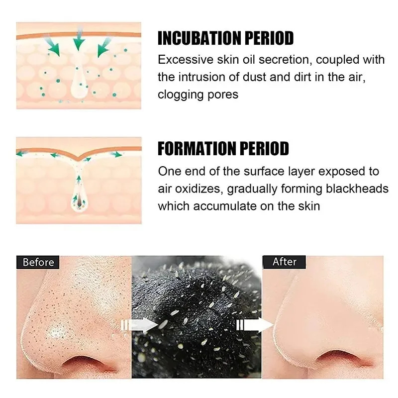 10/150PCS Blackhead Remove Mas - Charcoal Pore Strip 评论和价格